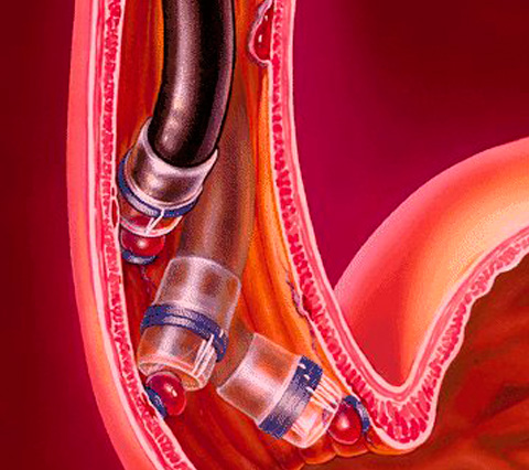 Proceso de ligadura de hemorroides en Bogot